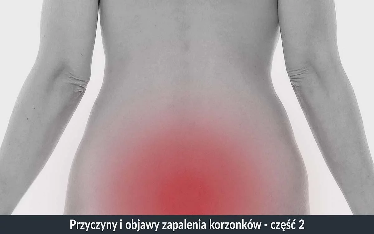 korzonki objawy zapalenia korzonków